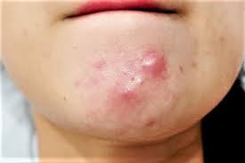 Bị Nổi Mụn Do Rối Loạn Nội Tiết