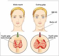 Cường giáp hoặc suy giáp