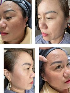 Điều Trị Chuyên Biệt – Nám, Mụn, Tàn Nhang, Chàm, Bớt